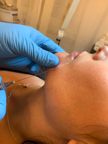 botox och fillers behandlingar